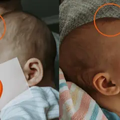 Dwa ujęcia główki niemowlaka. Na pierwszym widać lekko uwypuklone ciemiączko, na drugim jest ono bardziej płaskie.