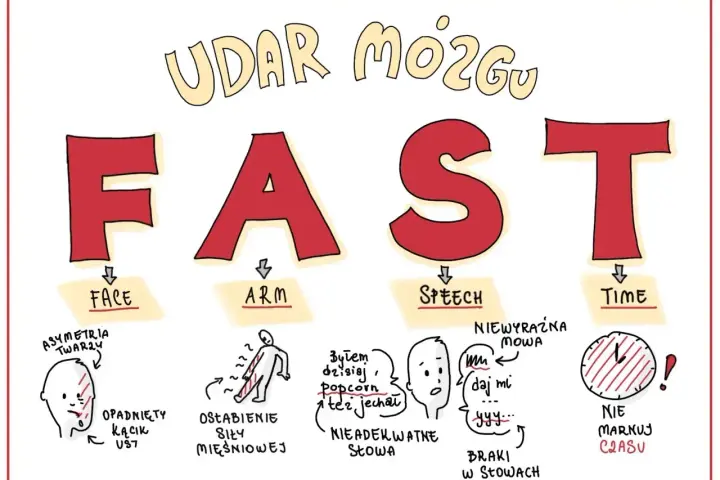 Objawy udaru mózgu: FAST. Asymetria twarzy, osłabienie siły mięśniowej, nieadekwatne słowa, braki w słowach, niewyraźna mowa, nie marnuj czasu. Czasownik to czynność, np. "daj mi".