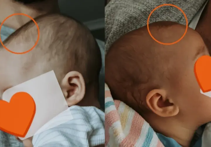 Dwa ujęcia główki niemowlaka. Na pierwszym widać lekko uwypuklone ciemiączko, na drugim jest ono bardziej płaskie.