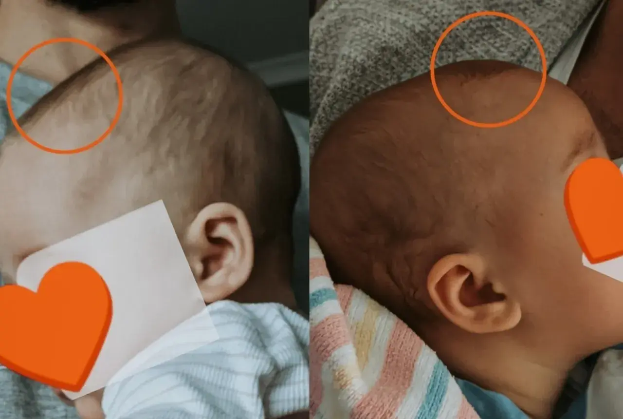 Dwa ujęcia główki niemowlaka. Na pierwszym widać lekko uwypuklone ciemiączko, na drugim jest ono bardziej płaskie.